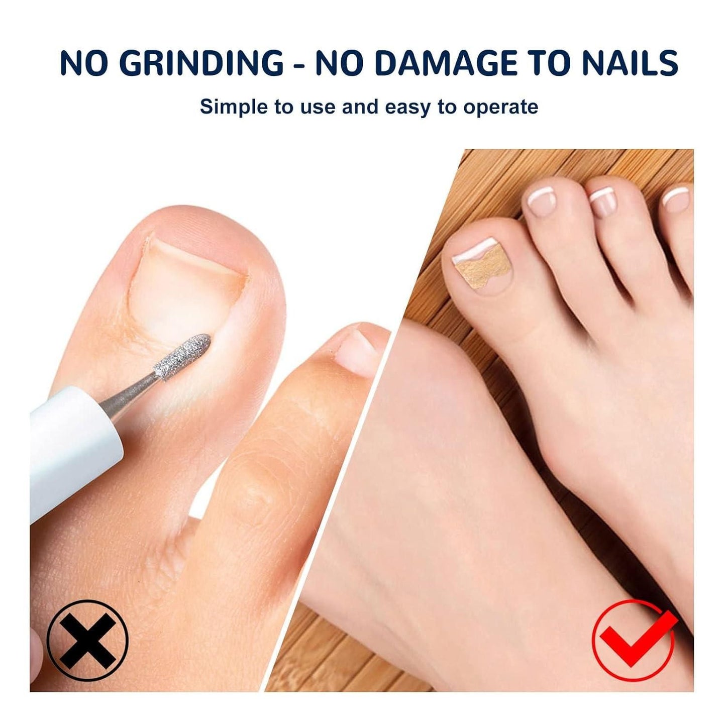 Ingrown Toenail Corrector Stickers (Nail Corrector)