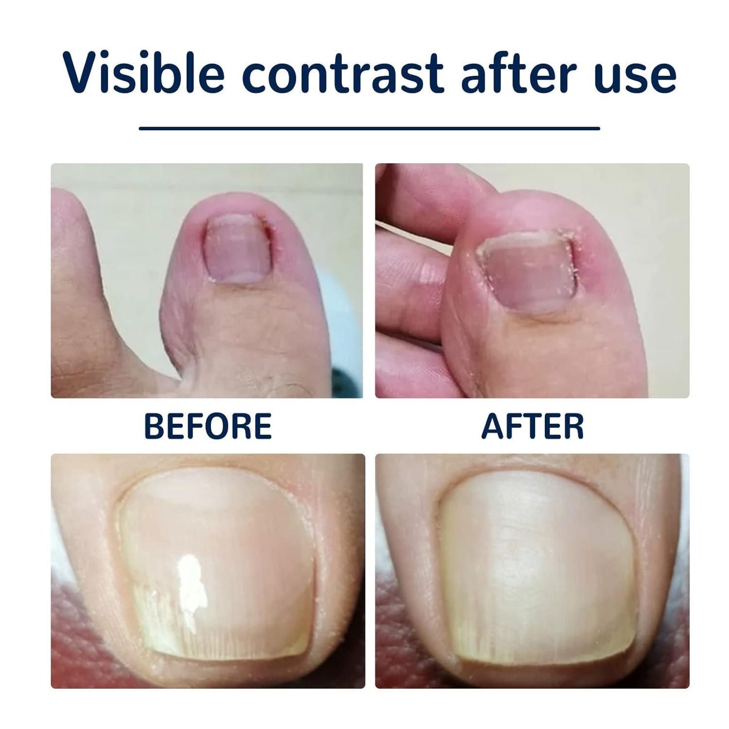 Ingrown Toenail Corrector Stickers (Nail Corrector)