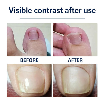 Ingrown Toenail Corrector Stickers (Nail Corrector)
